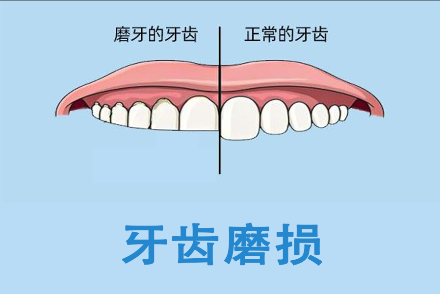 牙齿磨损|磨牙