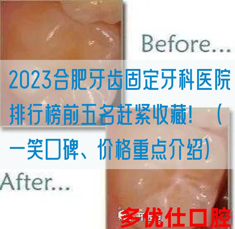 2023合肥牙齿固定牙科医院排行榜前五名赶紧收藏！（一笑口碑、价格重点介绍）