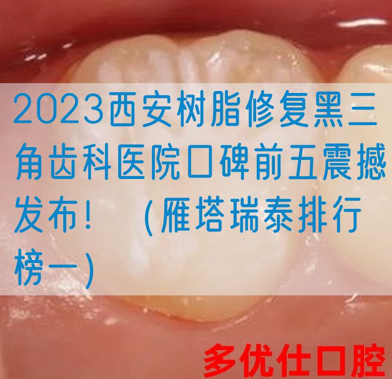 2023西安树脂修复黑三角齿科医院口碑前五震撼发布！（雁塔瑞泰排行榜一）