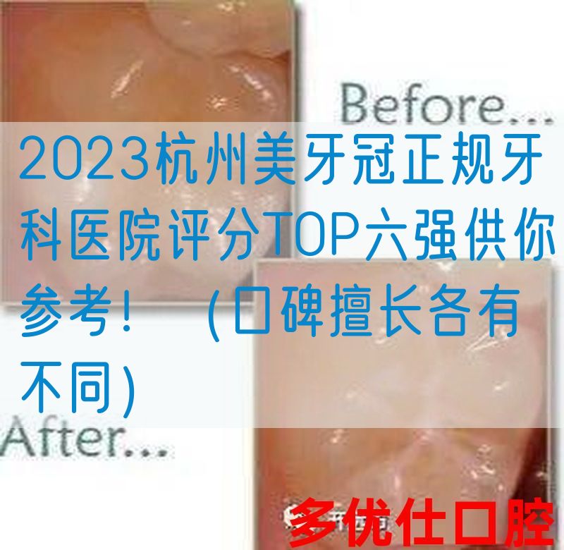 2023杭州美牙冠正规牙科医院评分TOP六强供你参考！（口碑擅长各有不同）