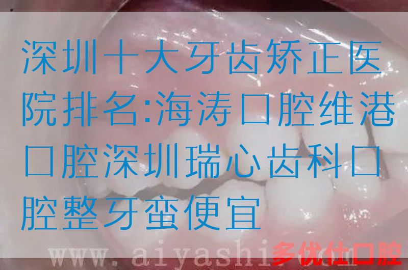 深圳*牙齿矫正医院排名:海涛口腔维港口腔深圳瑞心齿科口腔整牙蛮便宜