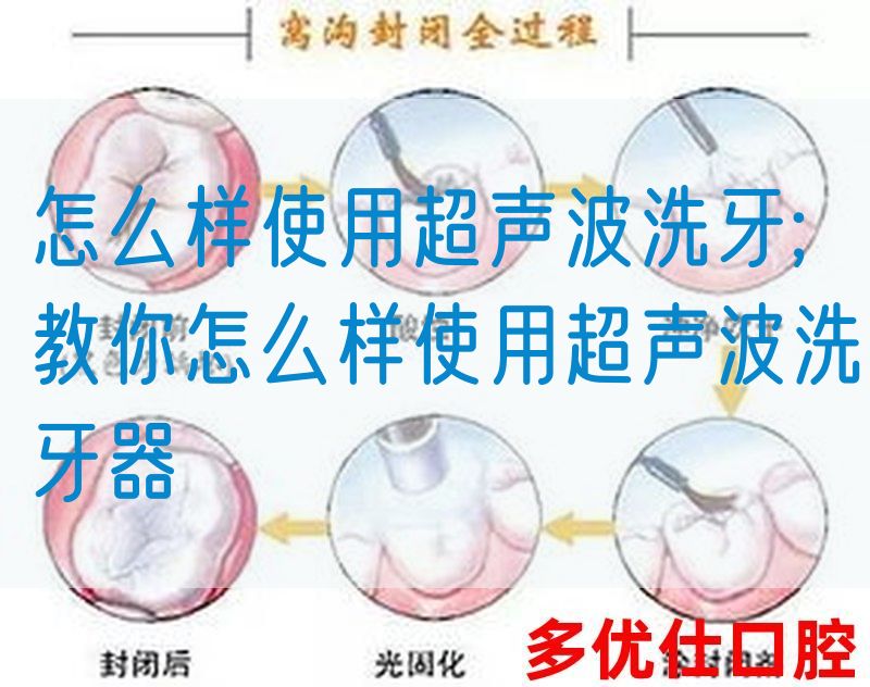 怎么样使用超声波洗牙;教你怎么样使用超声波洗牙器