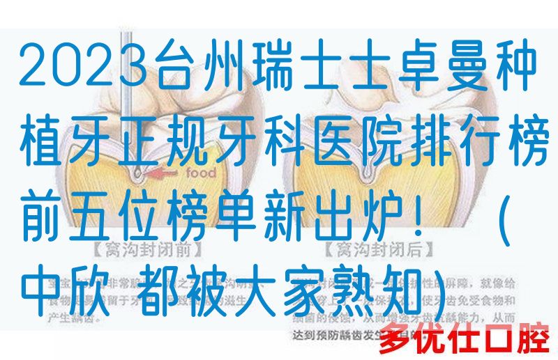 2023台州瑞士士卓曼种植牙正规牙科医院排行榜前五位榜单新出炉！（中欣 都被大家熟知）