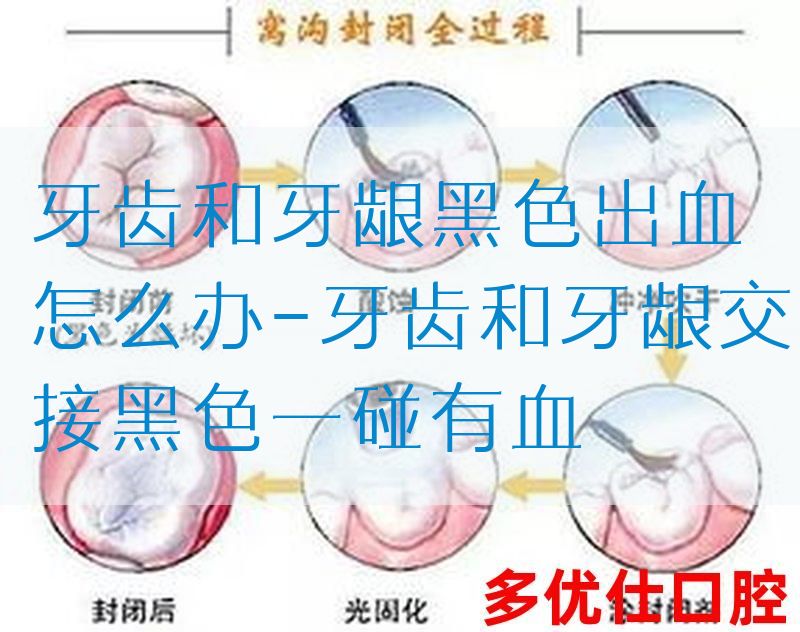 牙齿和牙龈黑色出血怎么办-牙齿和牙龈交接黑色一碰有血