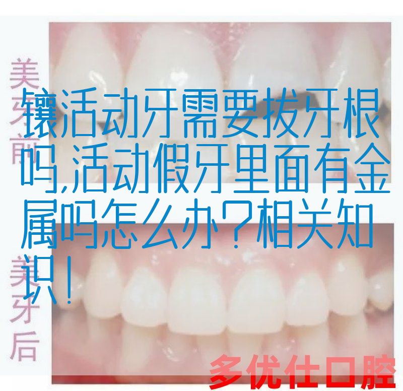 镶活动牙需要拔牙根吗,活动假牙里面有金属吗怎么办？相关知识！(图1)