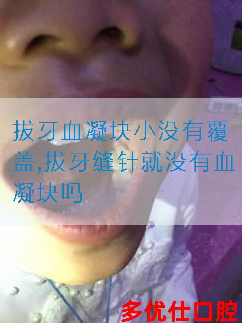 拔牙血凝块小没有覆盖,拔牙缝针就没有血凝块吗