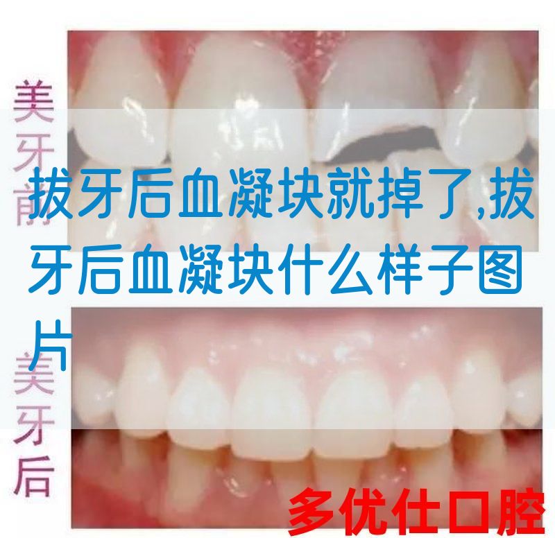 拔牙后血凝块就掉了,拔牙后血凝块什么样子图片