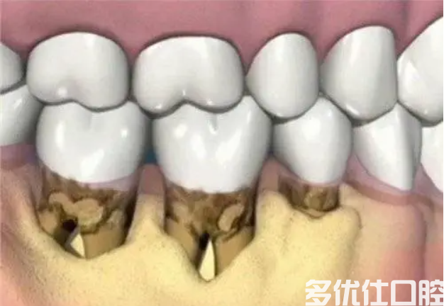 牙齿为什么会被腐蚀呢？如何预防呢？牙齿根部腐蚀初期图片