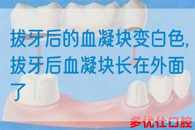 拔牙后的血凝块变白色,拔牙后血凝块长在外面了