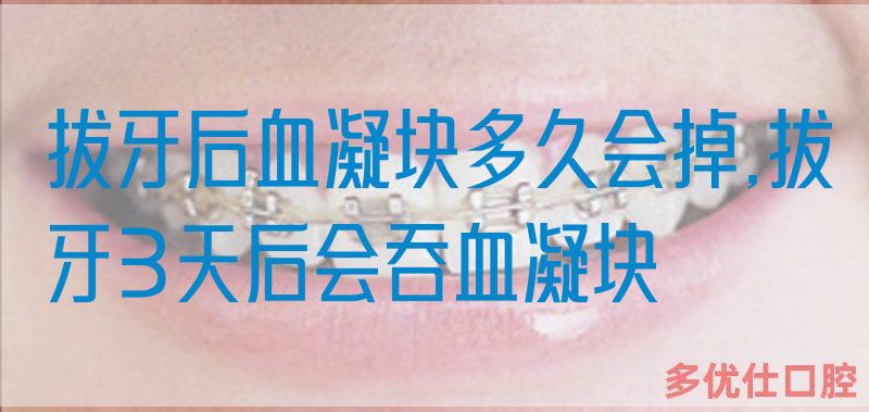 拔牙后血凝块多久会掉,拔牙3天后会吞血凝块
