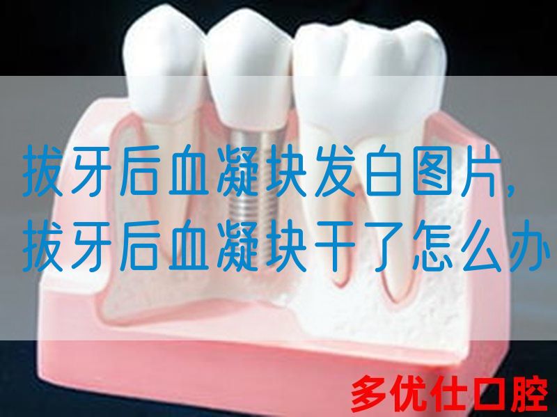 拔牙后血凝块发白图片,拔牙后血凝块干了怎么办