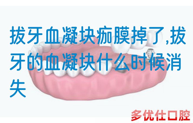 拔牙血凝块痂膜掉了,拔牙的血凝块什么时候消失