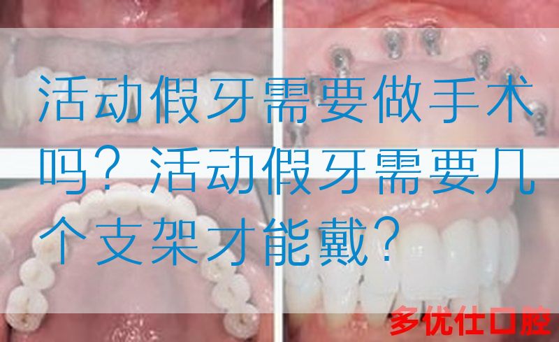 活动假牙需要做手术吗？活动假牙需要几个支架才能戴？(图1)