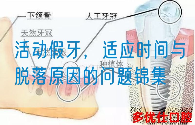 活动假牙，适应时间与脱落原因的问题锦集(图1)