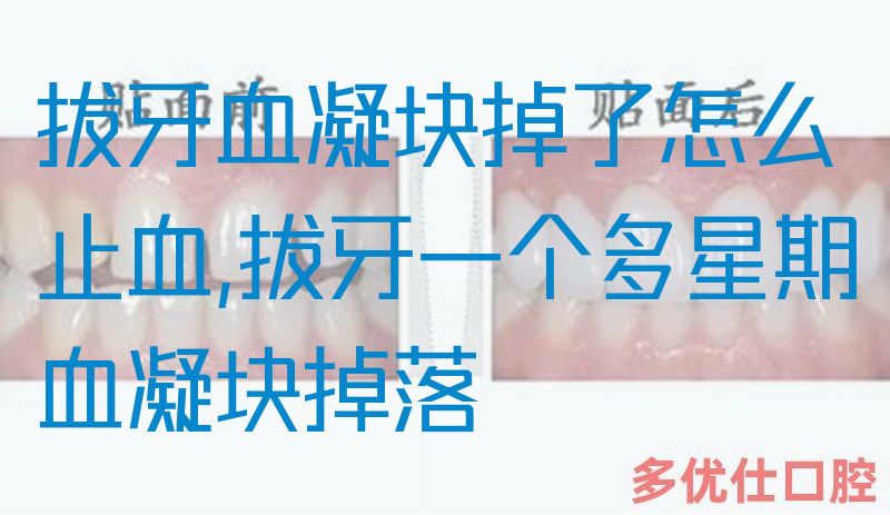 拔牙血凝块掉了怎么止血,拔牙一个多星期血凝块掉落