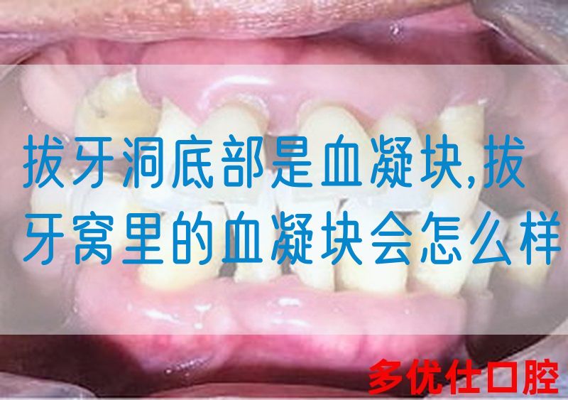 拔牙洞底部是血凝块,拔牙窝里的血凝块会怎么样