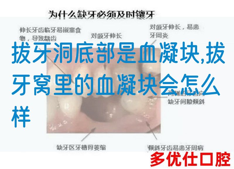 拔牙洞底部是血凝块,拔牙窝里的血凝块会怎么样(图1)