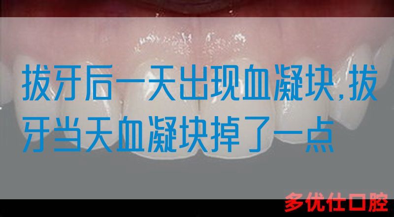 拔牙后一天出现血凝块,拔牙当天血凝块掉了一点(图1)