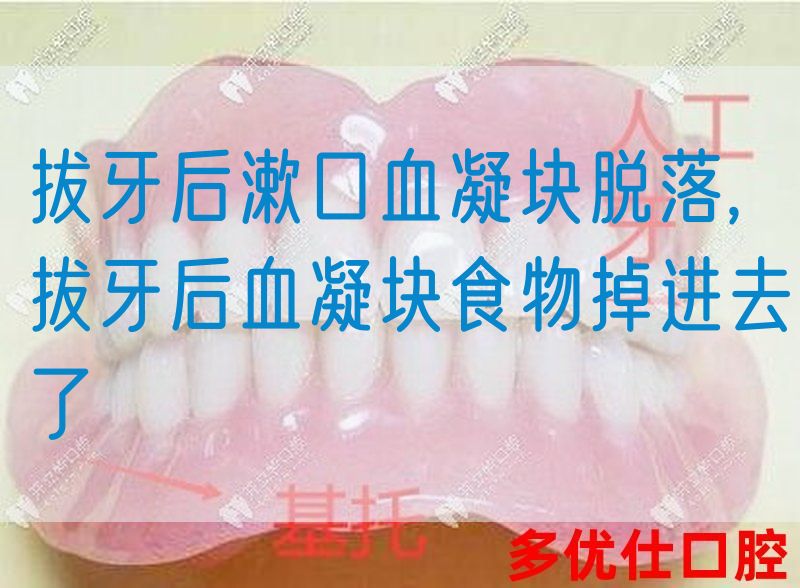 拔牙后漱口血凝块脱落,拔牙后血凝块食物掉进去了