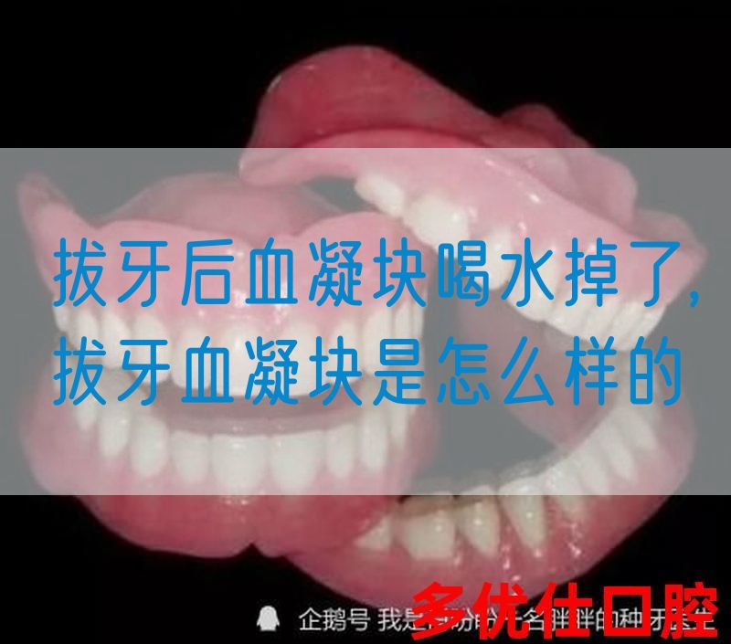 拔牙后血凝块喝水掉了,拔牙血凝块是怎么样的(图1)