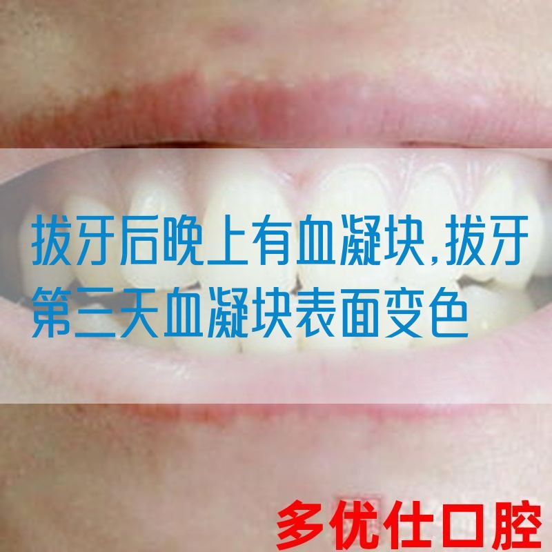 拔牙后晚上有血凝块,拔牙第三天血凝块表面变色(图1)