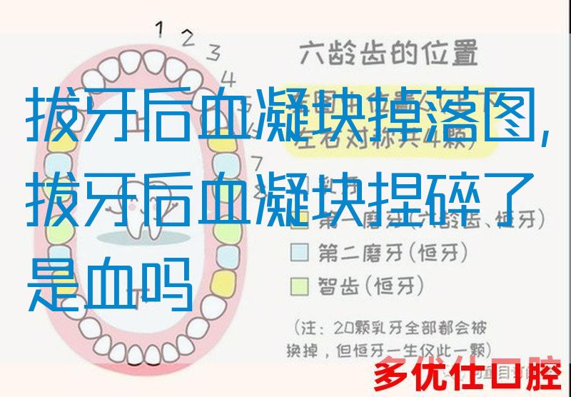 拔牙后血凝块掉落图,拔牙后血凝块捏碎了是血吗(图1)