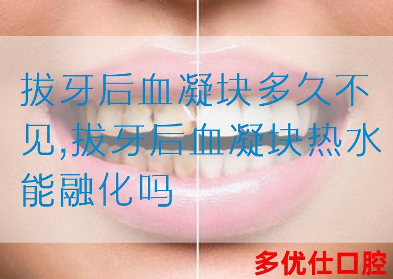 拔牙后血凝块多久不见,拔牙后血凝块热水能融化吗(图1)