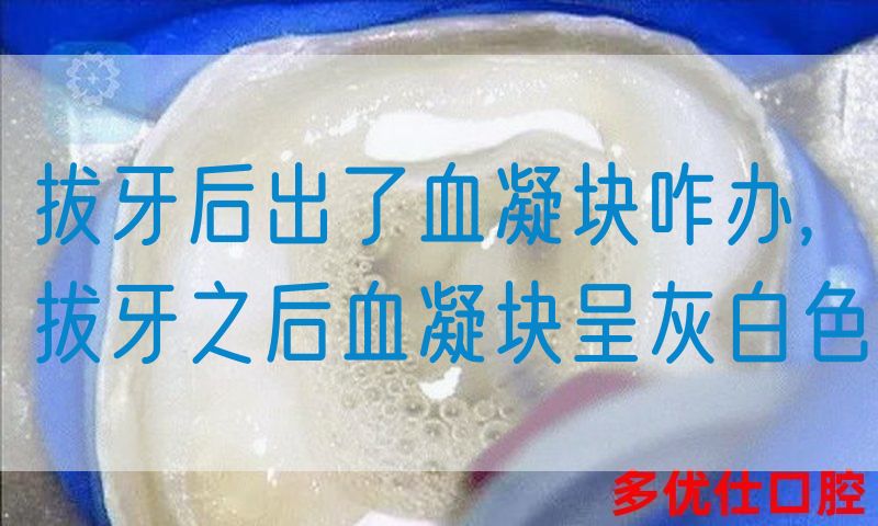 拔牙后出了血凝块咋办,拔牙之后血凝块呈灰白色