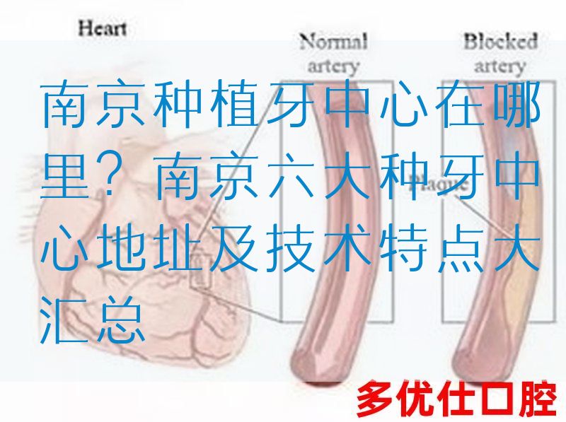 南京种植牙中心在哪里？南京六大种牙中心地址及技术特点大汇总