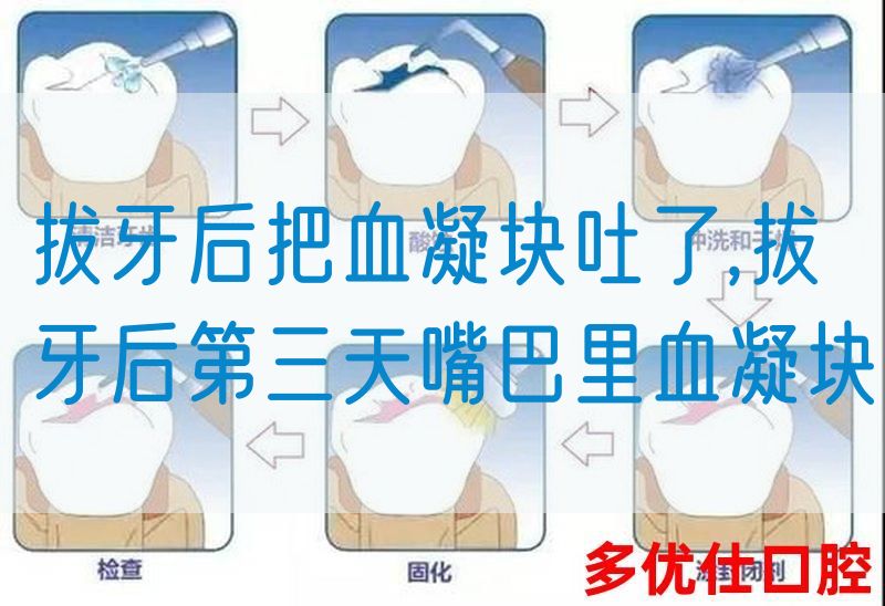 拔牙后把血凝块吐了,拔牙后第三天嘴巴里血凝块(图1)
