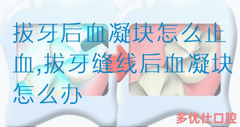 拔牙后血凝块怎么止血,拔牙缝线后血凝块怎么办