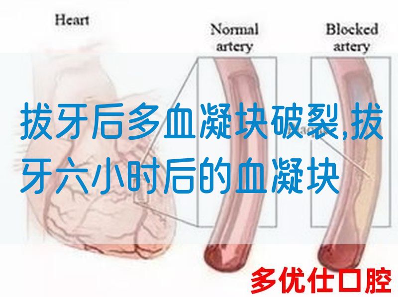 拔牙后多血凝块破裂,拔牙六小时后的血凝块(图1)