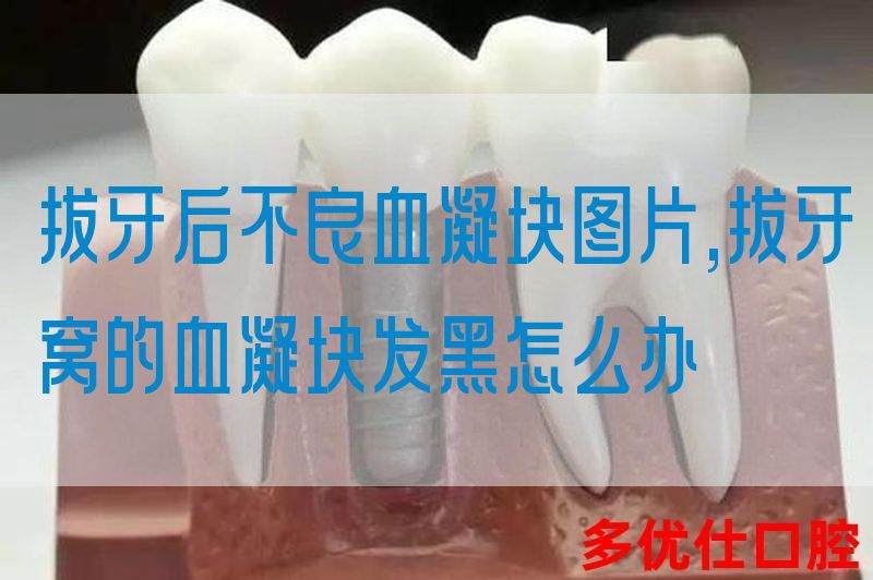 拔牙后不良血凝块图片,拔牙窝的血凝块发黑怎么办(图1)