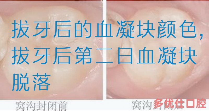 拔牙后的血凝块颜色,拔牙后第二日血凝块脱落(图1)