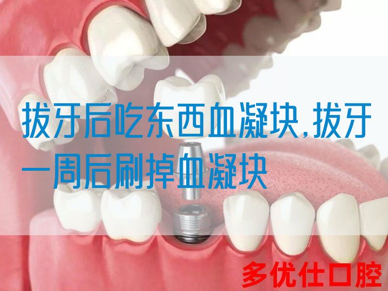 拔牙后吃东西血凝块,拔牙一周后刷掉血凝块(图1)