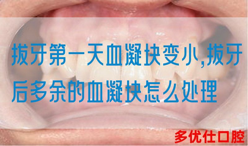 拔牙第一天血凝块变小,拔牙后多余的血凝块怎么处理(图1)