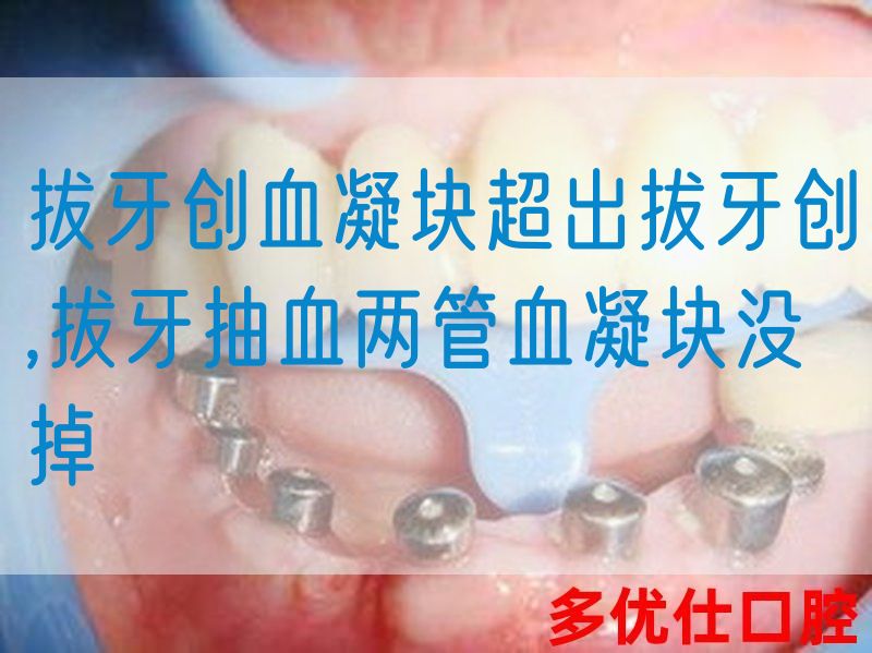 拔牙创血凝块超出拔牙创,拔牙抽血两管血凝块没掉(图1)
