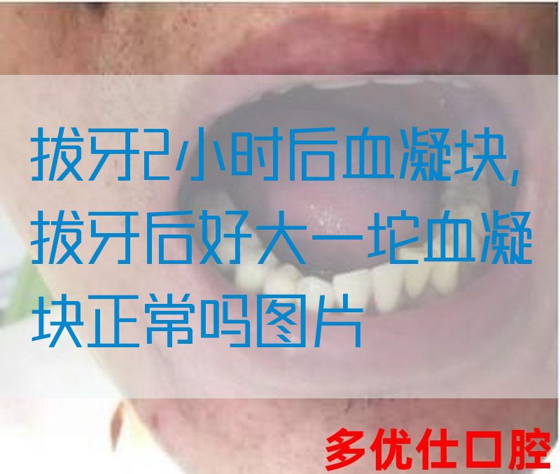 拔牙2小时后血凝块,拔牙后好大一坨血凝块正常吗图片(图1)