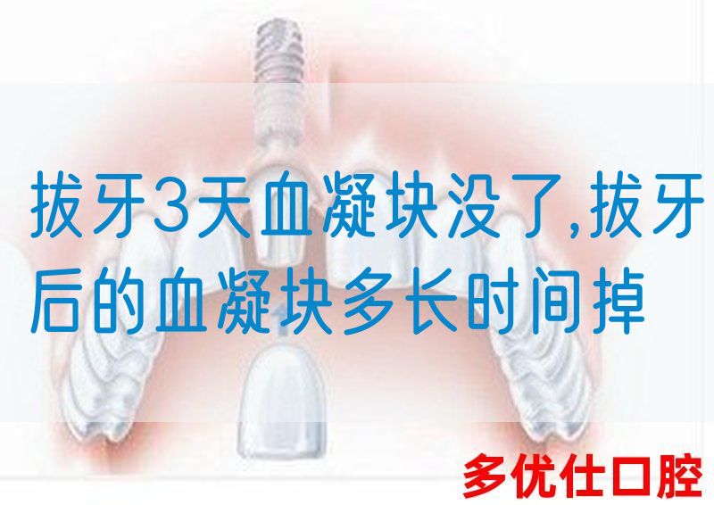 拔牙3天血凝块没了,拔牙后的血凝块多长时间掉(图1)