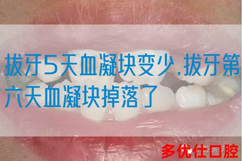 拔牙5天血凝块变少,拔牙第六天血凝块掉落了(图1)