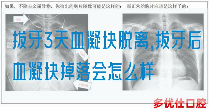 拔牙3天血凝块脱离,拔牙后血凝块掉落会怎么样(图1)