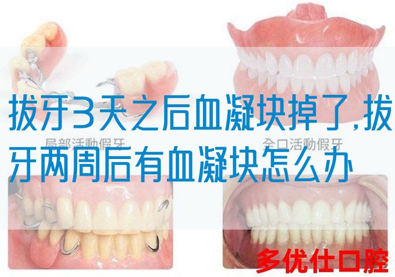 拔牙3天之后血凝块掉了,拔牙两周后有血凝块怎么办(图1)