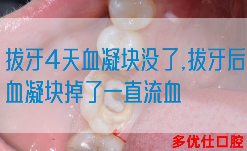 拔牙4天血凝块没了,拔牙后血凝块掉了一直流血(图1)
