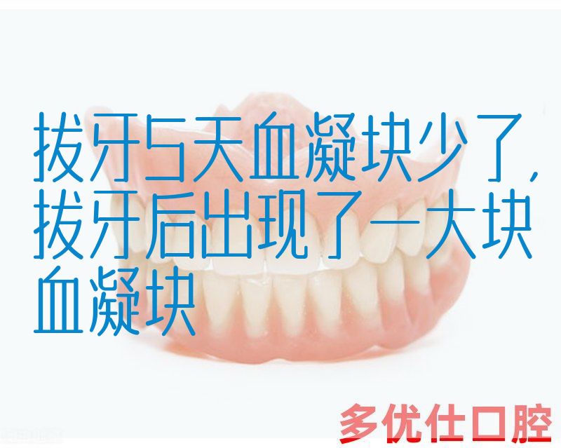 拔牙5天血凝块少了,拔牙后出现了一大块血凝块(图1)