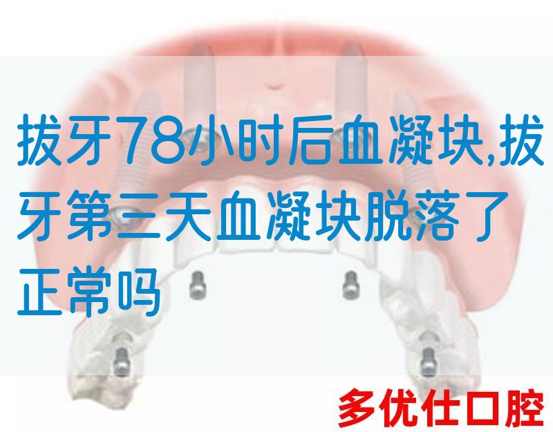 拔牙78小时后血凝块,拔牙第三天血凝块脱落了正常吗(图1)