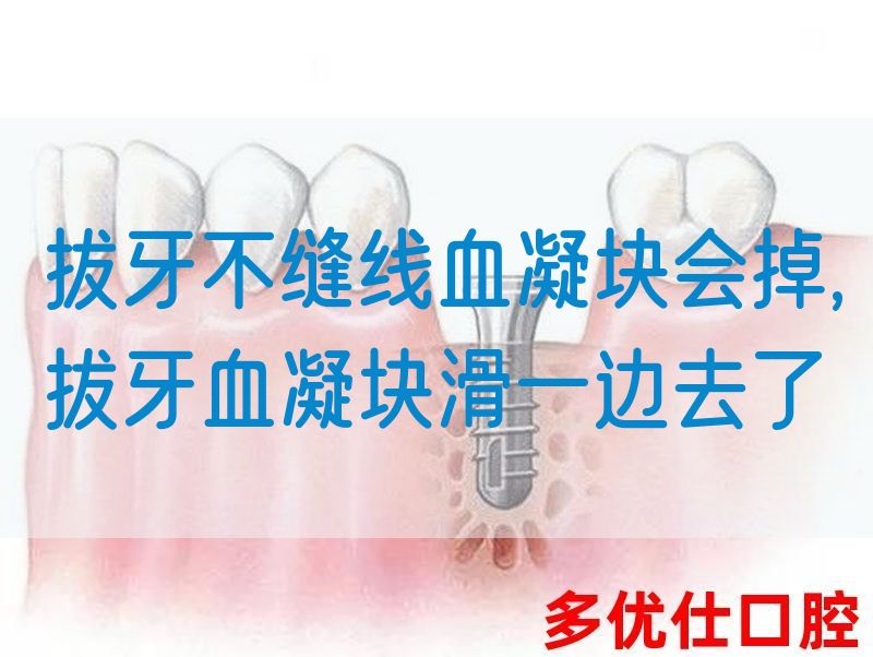 拔牙不缝线血凝块会掉,拔牙血凝块滑一边去了(图1)