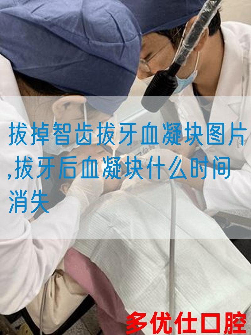 拔掉智齿拔牙血凝块图片,拔牙后血凝块什么时间消失(图1)