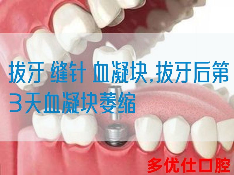 拔牙 缝针 血凝块,拔牙后第3天血凝块萎缩(图1)