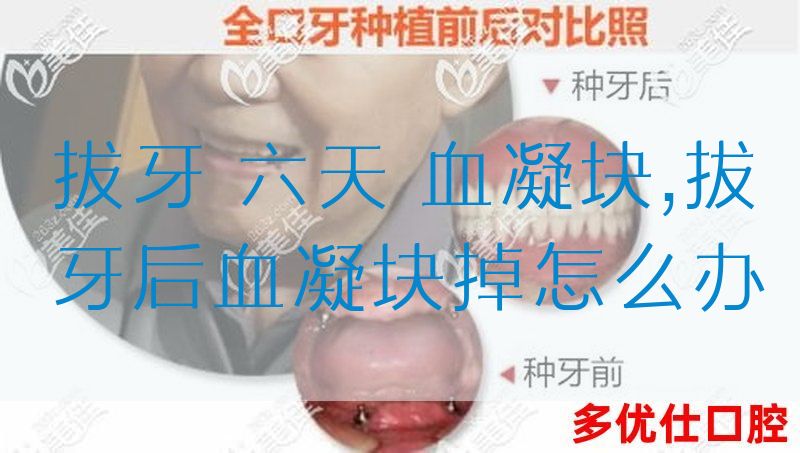 拔牙 六天 血凝块,拔牙后血凝块掉怎么办(图1)
