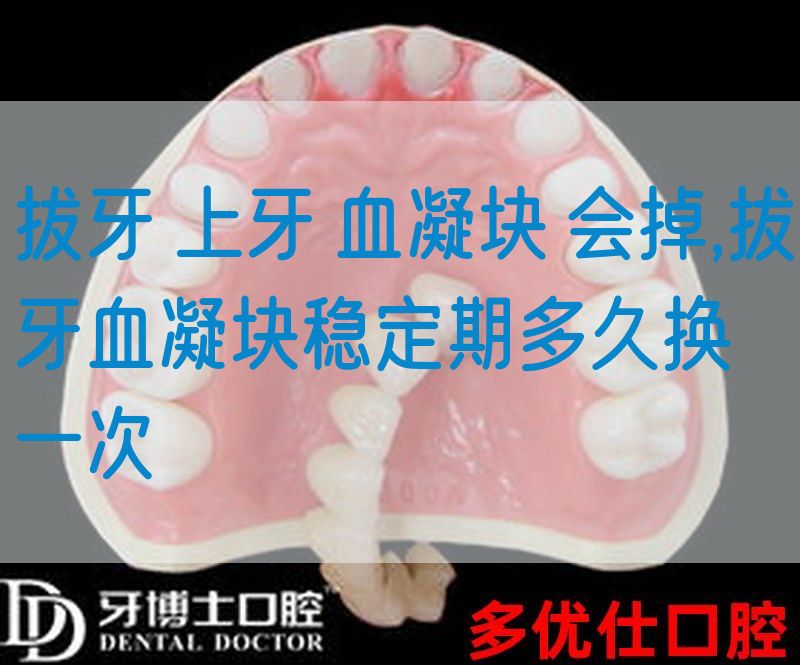 拔牙 上牙 血凝块 会掉,拔牙血凝块稳定期多久换一次(图1)